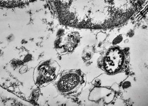 F,49y. | phagocytosed microbes - purulent meningitis F,49y. | phagocytosed microbes - purulent meningitis
